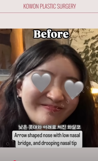 긴코수술은 어떻게 이루어질까? 그리고 화살코, 처진코원인은? 사진 9