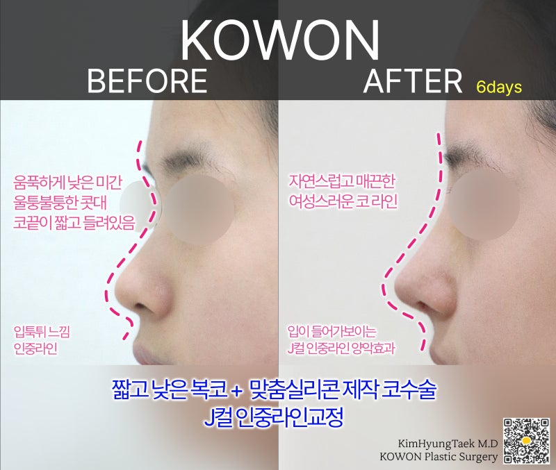 낮은코 성형, 코보형물을 사용하여 비중격만곡증 교정까지 할 수 있습니다. 사진 4