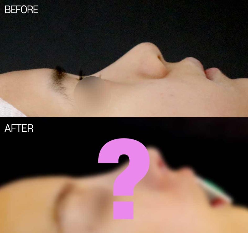 낮은코 성형, 코보형물을 사용하여 비중격만곡증 교정까지 할 수 있습니다.