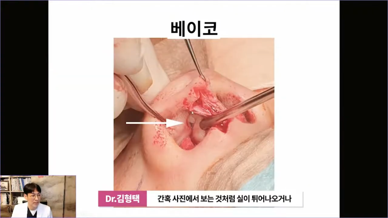 베이코 코실리프팅 시술 후 이물질제거하는 이유는 뭘까? 사진 6