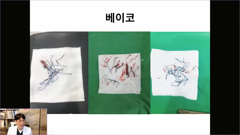 베이코 코실리프팅 시술 후 이물질제거하는 이유는 뭘까? 사진 11