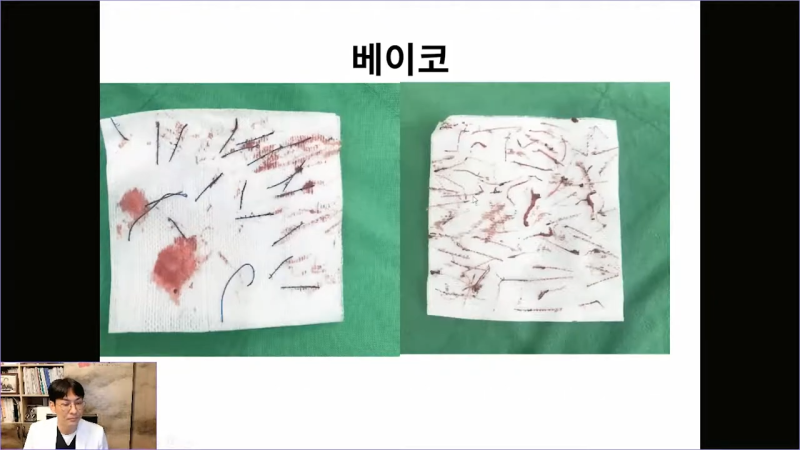 베이코 코실리프팅 시술 후 이물질제거하는 이유는 뭘까? 사진 10