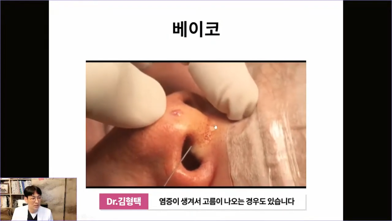 베이코 코실리프팅 시술 후 이물질제거하는 이유는 뭘까? 사진 8