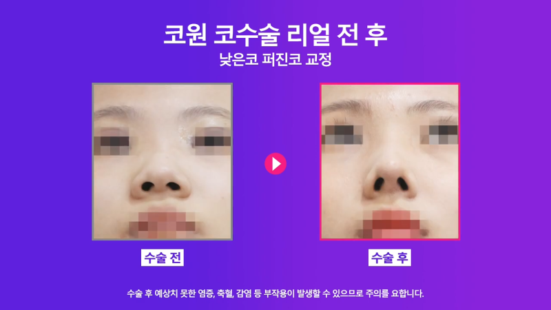 낮은코성형, 코끝올리기를 통한 성공적인 퍼진코 교정 사례 사진 6