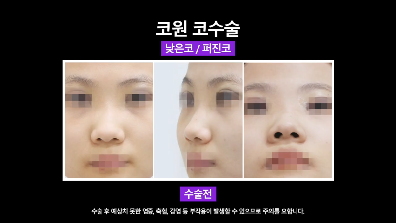 낮은코성형, 코끝올리기를 통한 성공적인 퍼진코 교정 사례 사진 4