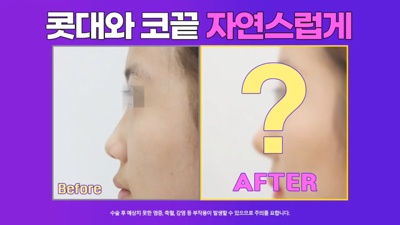 낮은코성형, 코끝올리기를 통한 성공적인 퍼진코 교정 사례