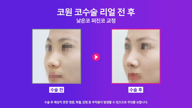 낮은코성형, 코끝올리기를 통한 성공적인 퍼진코 교정 사례 사진 7