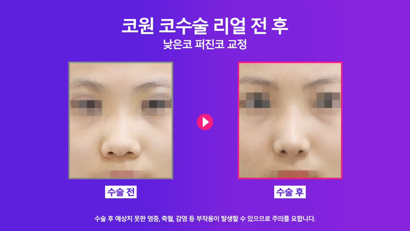 낮은코성형, 코끝올리기를 통한 성공적인 퍼진코 교정 사례 사진 5