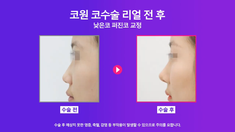 낮은코성형, 코끝올리기를 통한 성공적인 퍼진코 교정 사례 사진 8