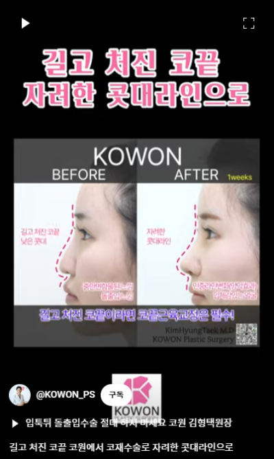 화살코 교정 긴코성형의 포인트! 자려한코가 되는 방법은? 사진 13
