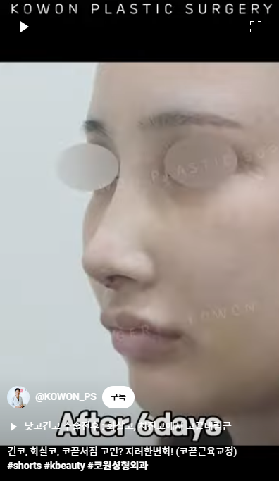 화살코 교정 긴코성형의 포인트! 자려한코가 되는 방법은? 사진 9