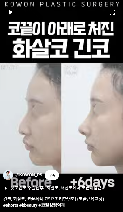 화살코 교정 긴코성형의 포인트! 자려한코가 되는 방법은? 사진 10