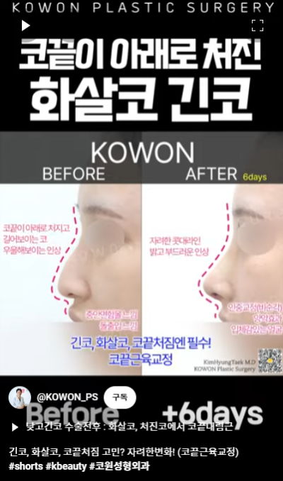 화살코 교정 긴코성형의 포인트! 자려한코가 되는 방법은? 사진 11