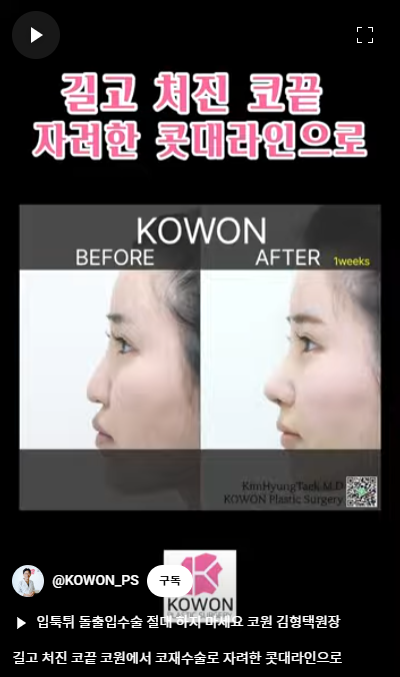 화살코 교정 긴코성형의 포인트! 자려한코가 되는 방법은? 사진 12