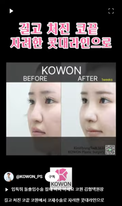 화살코 교정 긴코성형의 포인트! 자려한코가 되는 방법은? 사진 14