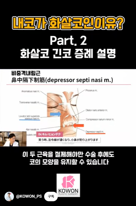 화살코 교정 긴코성형의 포인트! 자려한코가 되는 방법은?