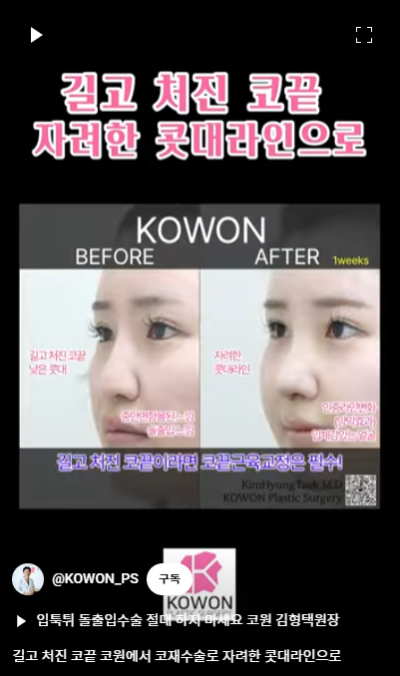 화살코 교정 긴코성형의 포인트! 자려한코가 되는 방법은? 사진 15