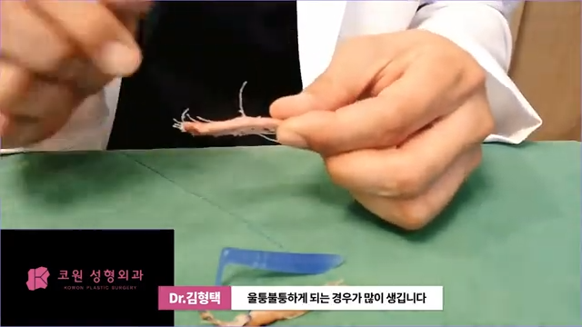 하이코 실리프팅 시술 후 염증 발생 가능성, 실제거 해야 할까? 사진 13