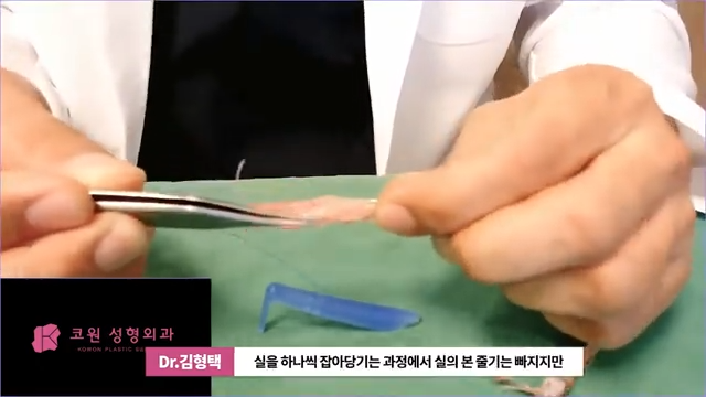 하이코 실리프팅 시술 후 염증 발생 가능성, 실제거 해야 할까? 사진 3