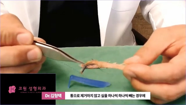 하이코 실리프팅 시술 후 염증 발생 가능성, 실제거 해야 할까?