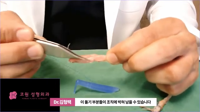 하이코 실리프팅 시술 후 염증 발생 가능성, 실제거 해야 할까? 사진 4