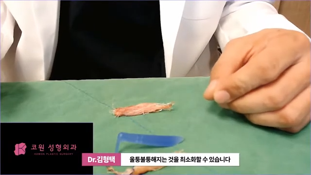 하이코 실리프팅 시술 후 염증 발생 가능성, 실제거 해야 할까? 사진 11