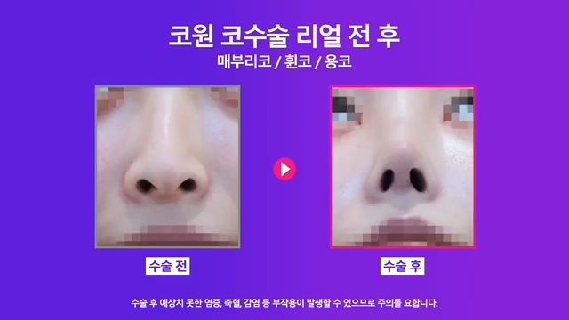 논현역성형외과 여자 매부리코 교정 후 화려한 코로 개선 성공한 사례 사진 6