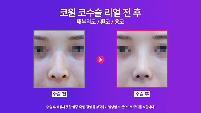 논현역성형외과 여자 매부리코 교정 후 화려한 코로 개선 성공한 사례 사진 5