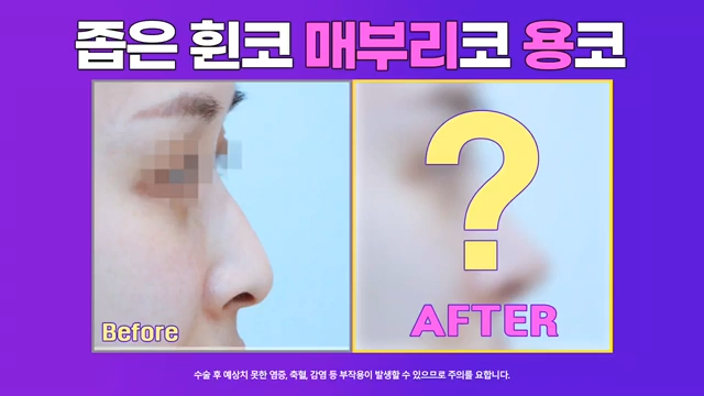 논현역성형외과 여자 매부리코 교정 후 화려한 코로 개선 성공한 사례