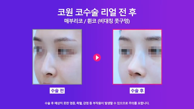 논현역성형외과 여자 매부리코 교정 후 화려한 코로 개선 성공한 사례 사진 7