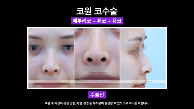 논현역성형외과 여자 매부리코 교정 후 화려한 코로 개선 성공한 사례 사진 4