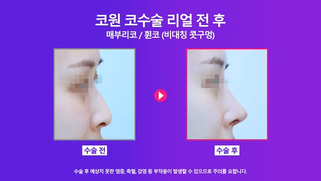 논현역성형외과 여자 매부리코 교정 후 화려한 코로 개선 성공한 사례 사진 8