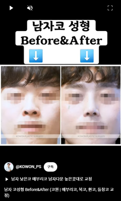 남자 코성형 자연스러운 직선코, 높은 콧대로 변신! 사진 11