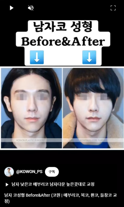 남자 코성형 자연스러운 직선코, 높은 콧대로 변신! 사진 9