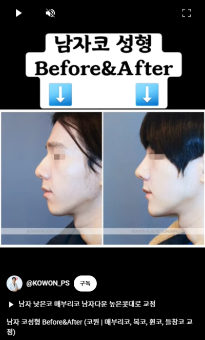 남자 코성형 자연스러운 직선코, 높은 콧대로 변신! 사진 10