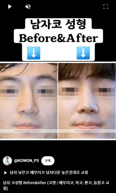 남자 코성형 자연스러운 직선코, 높은 콧대로 변신! 사진 13