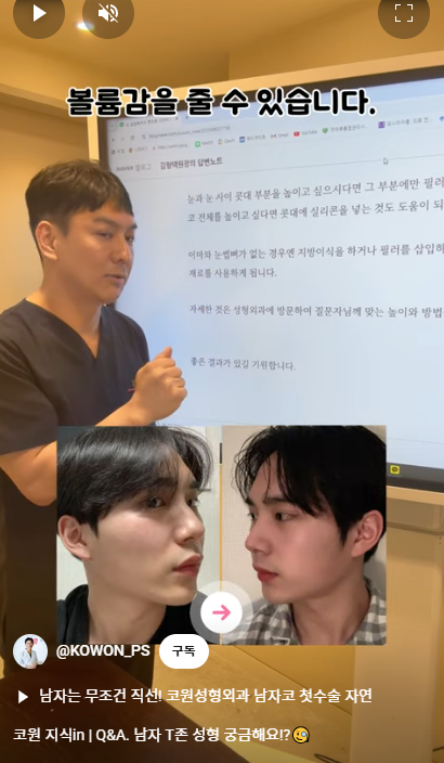 남자 코성형 자연스러운 직선코, 높은 콧대로 변신! 사진 8