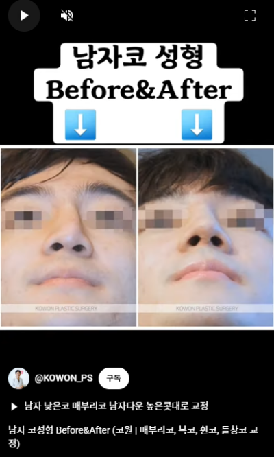 남자 코성형 자연스러운 직선코, 높은 콧대로 변신! 사진 14