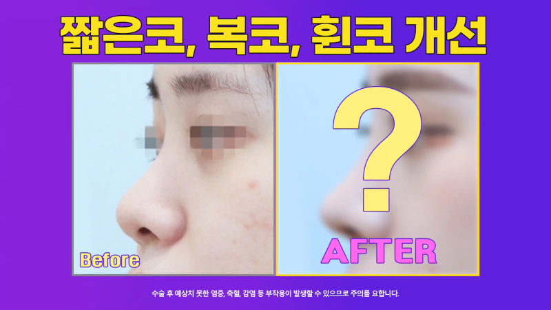 여자복코, 뚱뚱한코에서 화려하고 예쁜 코로 개선한 사례