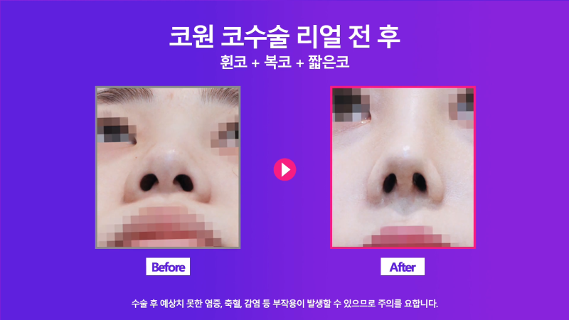 여자복코, 뚱뚱한코에서 화려하고 예쁜 코로 개선한 사례 사진 6