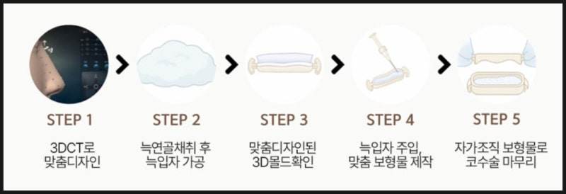 자가늑입자 보형물을 활용한 코성형의 진화, 염증없는 코성형