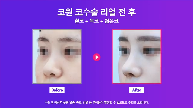 휜코교정 비중격연장으로 짧고 퍼진 콧대 개선한 사례 사진 7