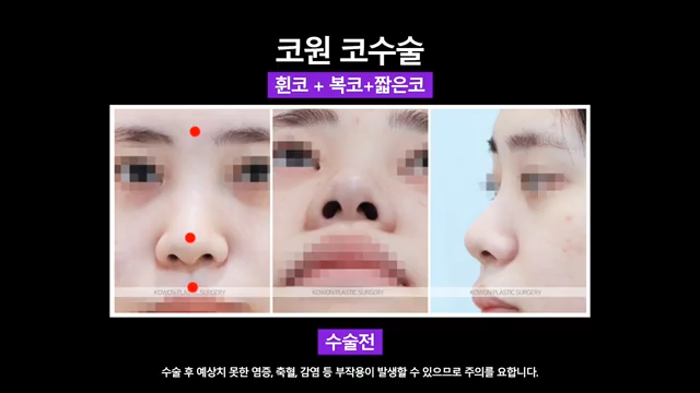 휜코교정 비중격연장으로 짧고 퍼진 콧대 개선한 사례 사진 4