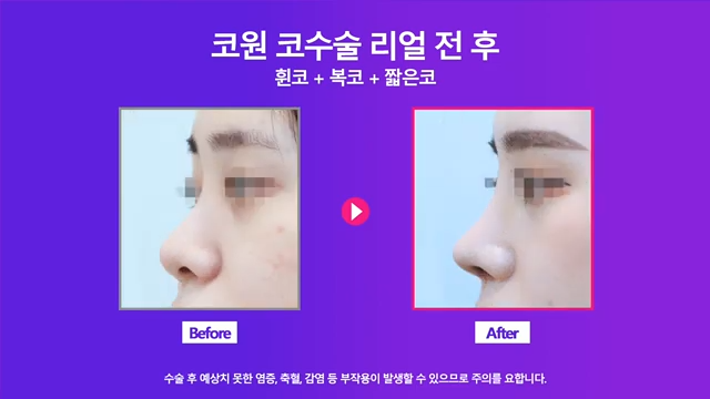 휜코교정 비중격연장으로 짧고 퍼진 콧대 개선한 사례 사진 8