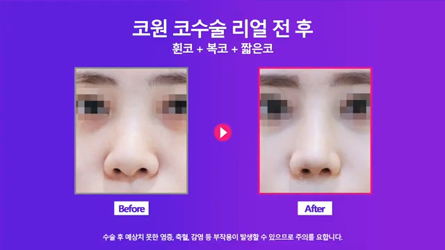 휜코교정 비중격연장으로 짧고 퍼진 콧대 개선한 사례 사진 5