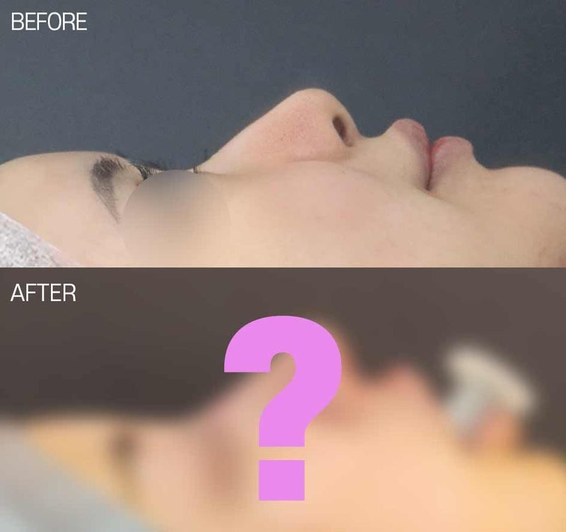 복코수술 비순각 교정 후 두툼한 코 개선할 수 있습니다.