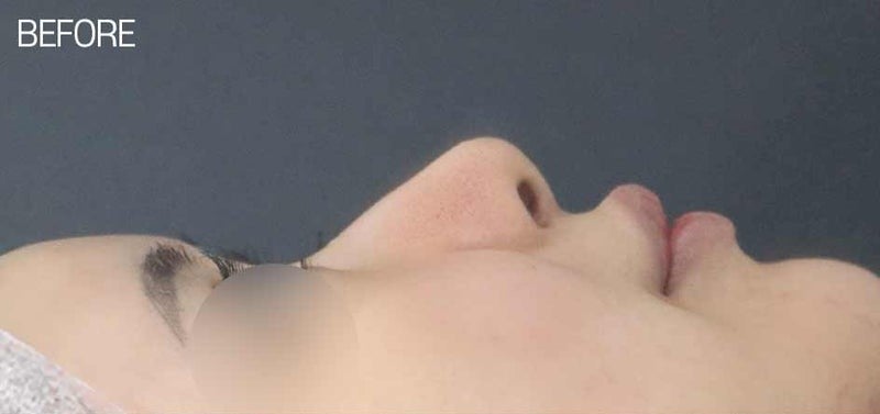 복코수술 비순각 교정 후 두툼한 코 개선할 수 있습니다. 사진 4