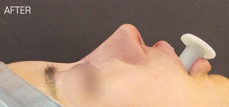복코수술 비순각 교정 후 두툼한 코 개선할 수 있습니다. 사진 5