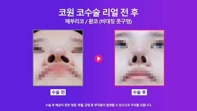 매부리코수술 코끝올리기로 콧구멍비대칭 개선한 사례 사진 5
