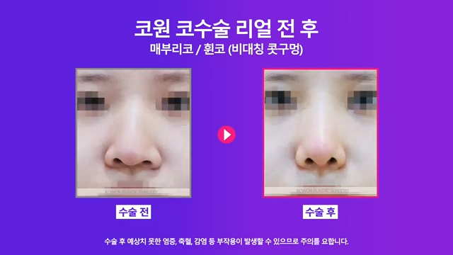 매부리코수술 코끝올리기로 콧구멍비대칭 개선한 사례 사진 6
